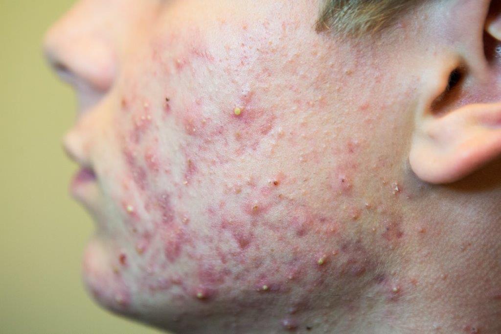 Wat is acne precies? | Vital Acne Instituut