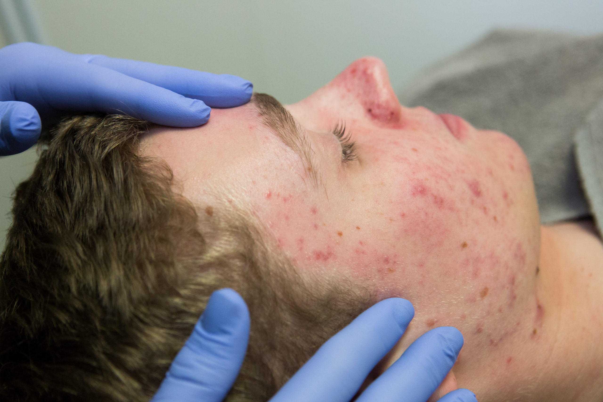 Ontstaan van acne | Vital Acne Instituut